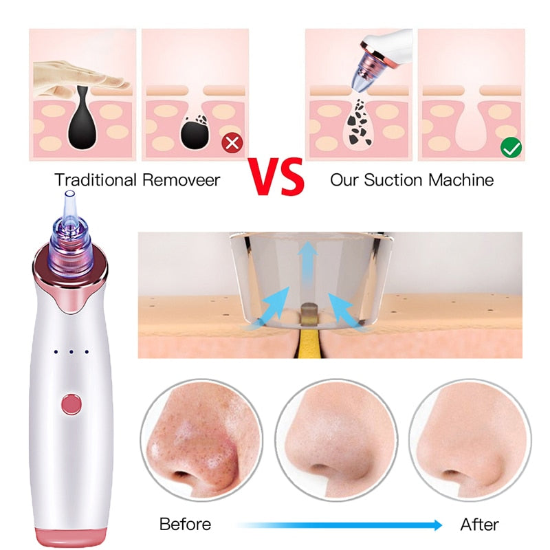 Pore Vacuum Blackhead Remover