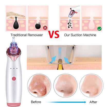 Pore Vacuum Blackhead Remover